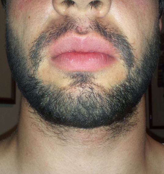 18-y-o-growing-full-beard-for-the-summer-2-5-weeks-in-beard-board